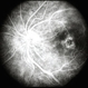 Intermediate Uveiris and CME